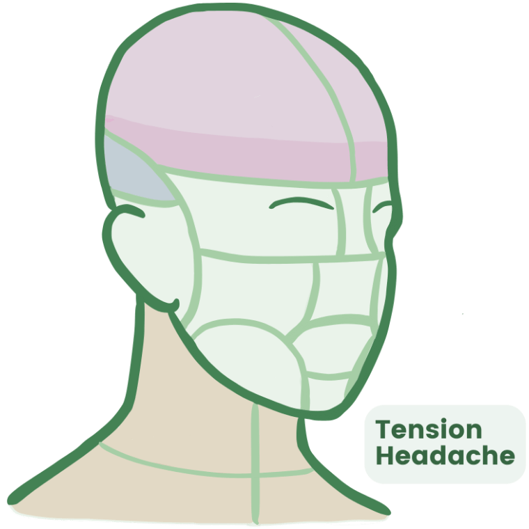 Where in your head tension headaches are located