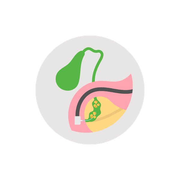 Cholestasis (bile duct blockage)