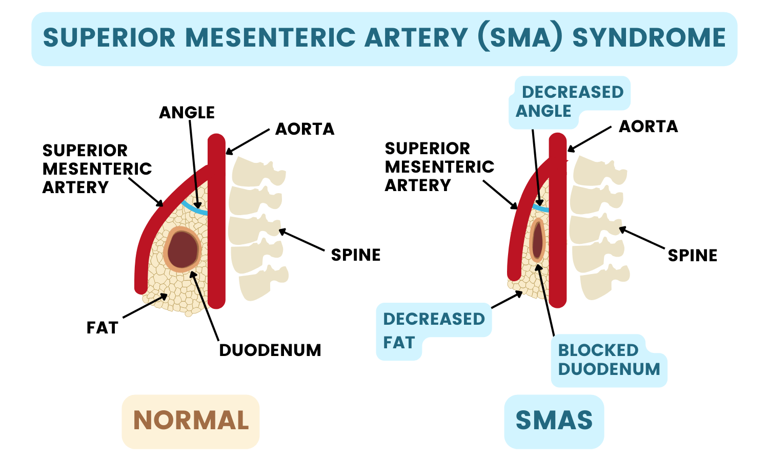 Superior Mesenteric Artery Syndrome Symptoms Superior Mesenteric Artery Syndrome Symptoms